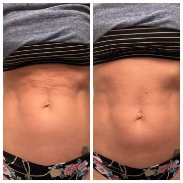 Evolve X Body Contouring Treatment Near Me in Shaker Heights, OH